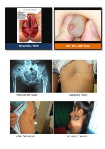 Nhận Dạng Trẻ Có Nhu Cầu Phẫu Thuật Hình ảnh 12