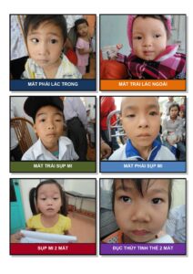 Nhận Dạng Trẻ Có Nhu Cầu Phẫu Thuật Hình ảnh 4