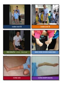 Nhận Dạng Trẻ Có Nhu Cầu Phẫu Thuật Hình ảnh 5
