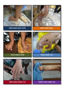 Nhận Dạng Trẻ Có Nhu Cầu Phẫu Thuật Hình ảnh 6