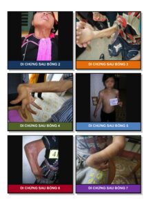 Nhận Dạng Trẻ Có Nhu Cầu Phẫu Thuật Hình ảnh 9