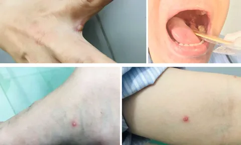Phân biệt bệnh đậu mùa khỉ và thủy đậu