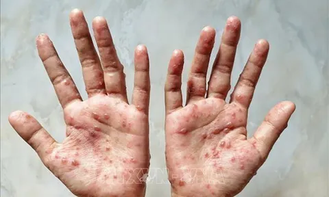 Những triệu chứng điển hình của bệnh ĐẬU MÙA KHỈ