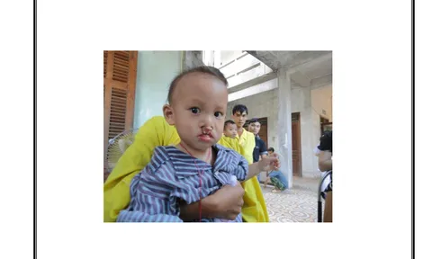 Nhận dạng trẻ khuyết tật có nhu cầu phẫu thuật Trung tâm II – Địa chỉ tin cậy kết nối phẫu thuật cho trẻ khuyết tật